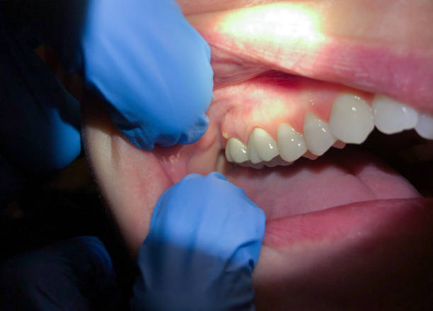 Best Chipped Tooth Repair Near Me  in Sunnyvale, TX